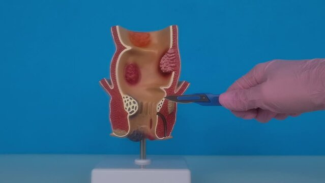 Doctor is holding scalpel anatomy of rectum problem. Surgical approach to treatment of chronic constipation