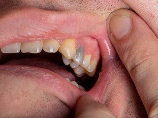 Black tooth in the mouth of a man after nerve depulpation. Dead darkened tooth, macro
