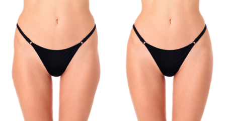 Closeup shot of female thighs before and after treatment, isolated
