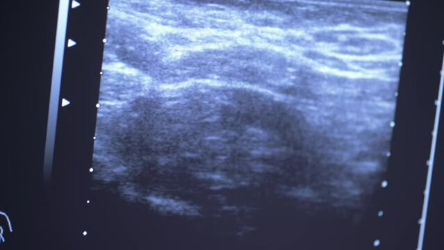 a close-up image on the monitor of the result of an ultrasound examination of the breast.