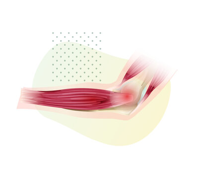 Lateral Epicondylitis known as Tennis Elbow - Stock Illustration