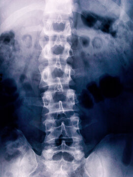 Spine with scoliosis seen by x-ray