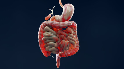 man suffering from crohns disease, male anatomy, inflamed large intestine, Sigmoid Colon, human digestive system parts, 3d render - obrazy, fototapety, plakaty
