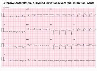 Extensive Anterolateral STEMI (ST-Elevation Myocardial Infarction) Acute - ECG Paper 12 Lead - Vector Medical Illustration