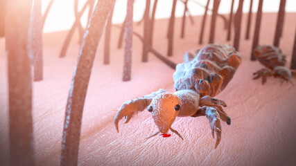 head louse on a human head 3d render