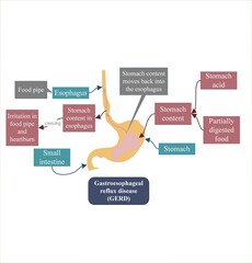 Gastroesophageal reflux disease is characterized by movement of stomach content back into the esophagus