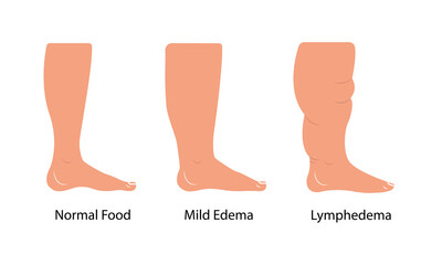 Lymphedema stages. Lymphatic system dysfunction disease. Swollen legs, lymph fluid transportation disorder. Flat vector illustration