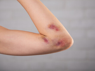 Close-up of bruises on the skin of an injured woman's arm