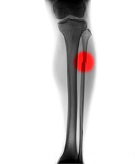 X-ray image of fracture leg bone