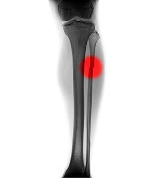 X-ray image of fracture leg bone