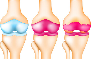 stage of knee cartilage destruction. 