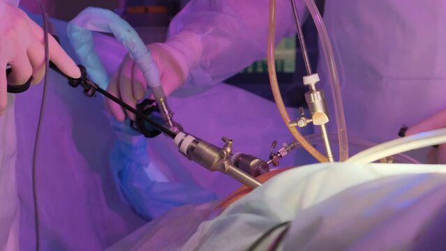 Laparoscopic cholecystectomy instrument. The surgeon's doing laparoscopic gastric sleeve surgery in the operating room