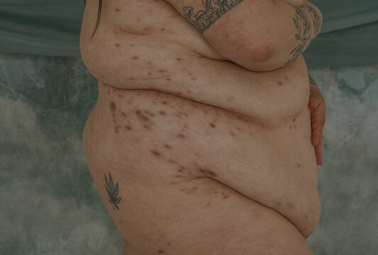 side profile of a fat torso with hidradenitis suppurativa texture