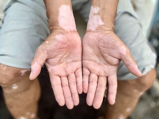 Portrait of Vitiligo on Skin from a Man, is a white patches caused by loss of pigmentation.