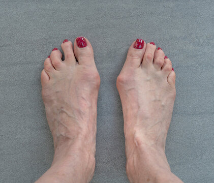 White female feet with bunion or hallux valgus.