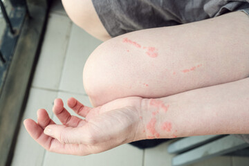 An allergic reaction on the skin from contact with a jellyfish