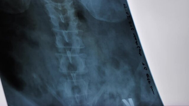Rengen, X-rey a close-up of the spine, spinal cord in an old elderly man. Examination by a neurologist in the hospital