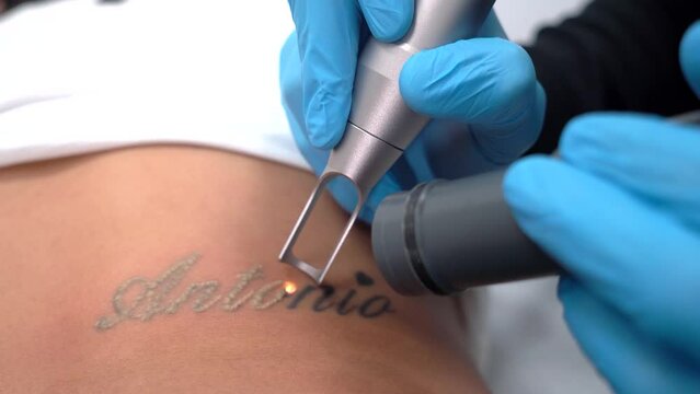 Girl erasing tattoo of exboyfriend name, deleting or removing. Dermatologist clinic tatto erase professionaly.