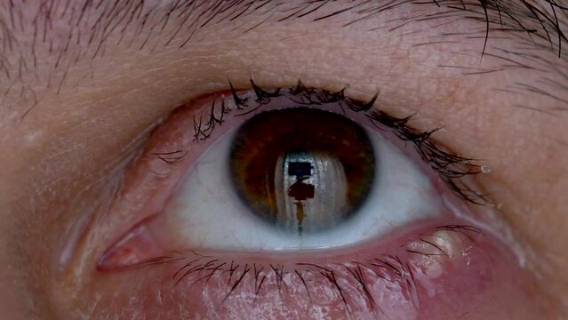 Macro view of a male eye with a swollen and inflamed eyelid, a symptom of a painful upper eyelid infection.