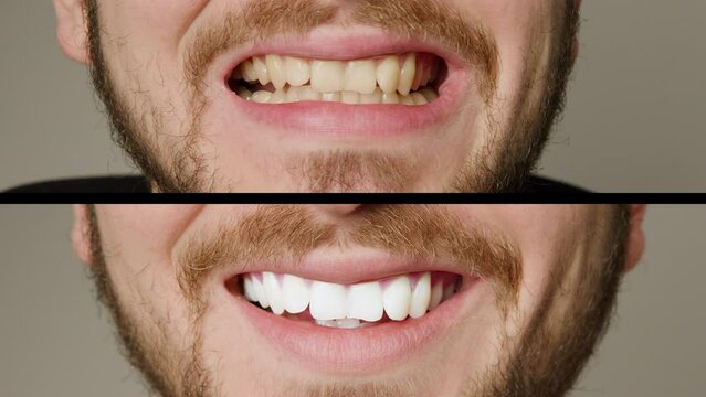 Collage of two superimposed pictures without background, before and after, without writing with a man's teeth. Teeth whitening treatment. Man smiling broadly after teeth whitening procedure