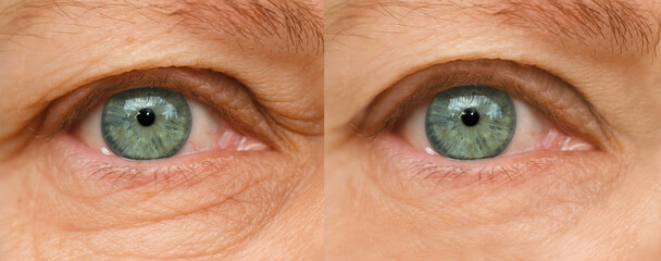 close up part of face mature woman 55 years old, human eye, lower, upper eyelid, deep wrinkles...