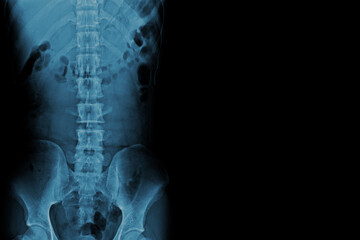 X-ray image of a normal human spine.