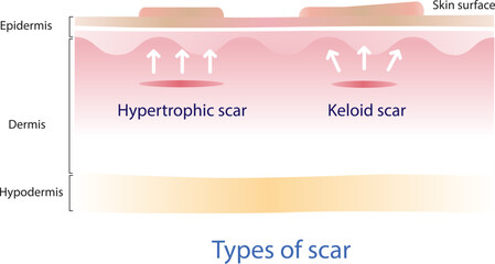 Type of keloid scar and hypertrophic scar on skin surface. Scars are caused by wounds that reach the dermis layer.