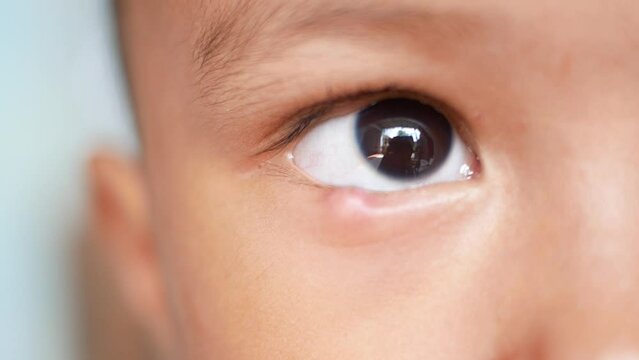 Closeup of Infected child eye patch with painful bump on lower eyelid. eye disease. blinking eyes