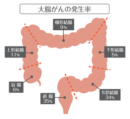 人間の体_大腸がんの発生率