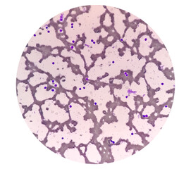 Blood Film or Peripheral blood smear: Microcytic hypochromic anemia with Thrombocytosis.