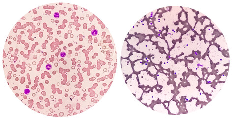 Blood Film or Peripheral blood smear: Microcytic hypochromic anemia with Thrombocytosis.