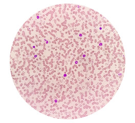 Blood Film or Peripheral blood smear: Microcytic hypochromic anemia with Thrombocytosis.