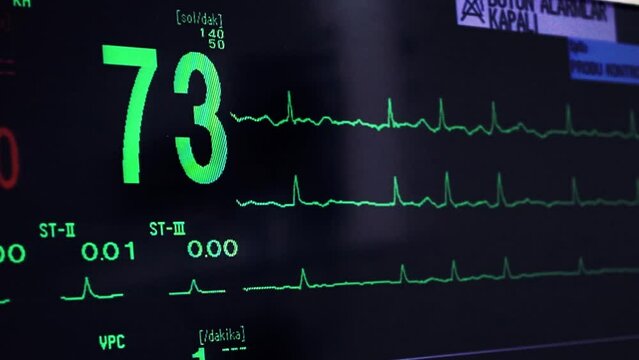 Heart signs in surgery. Screening patient heart. Vital signs monitor. Electrocardiogram stock video.