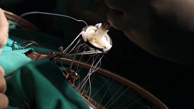 Suturing artificial heart valve. Close-up doctor hands and heart valve during cardiac surgery. By-pass procedure.