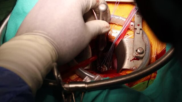 Installment of artificial heart valve by doctor during open surgery. Close-up doctor hands and heart valve during cardiac surgery. By-pass procedure.
