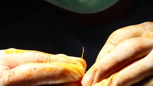 Close-up doctor threading a needle during real surgery. Application of preparing surgical suture.