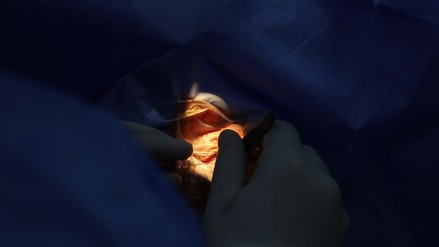 Close-up eye surgery. Surgical procedure stock video.