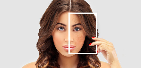 Obraz premium Dark spots, freckles,hyperpigmentation(melasma or chloasma),concept - skin lightening, skin whitening, fruit acids,AHA, Skin Brightening