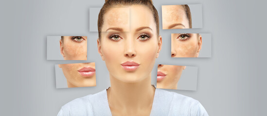 Dark spots, freckles,hyperpigmentation(melasma or chloasma),concept - skin lightening, skin...