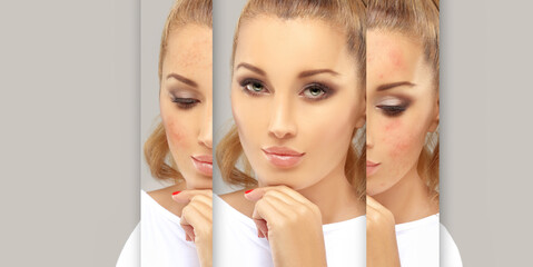 Dark spots, freckles,hyperpigmentation(melasma or chloasma),concept - skin lightening, skin whitening, fruit acids,AHA, Skin Brightening