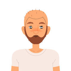 Man Character Doing Hair Transplantation Suffer from Alopecia or Baldness Vector Illustration