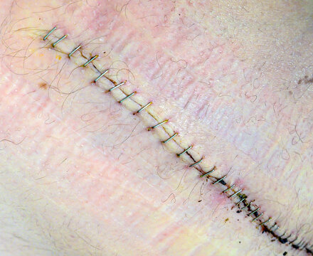 Many surgical staples holding a large wound closed. Skin is pink and yellow. Shallow depth of field, focus in center of frame.