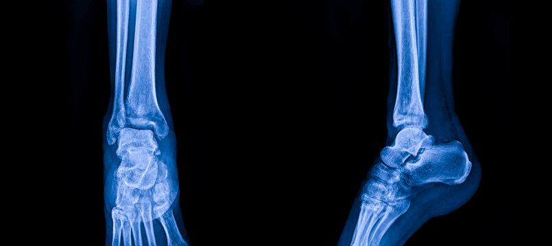 Blue tone radiograph on dark background in hospital.Doctor used an xray for diagnosis of the illness of patient.X-ray of ankle joint AP and lateral view in orthopedic surgery unit.Medical concept.