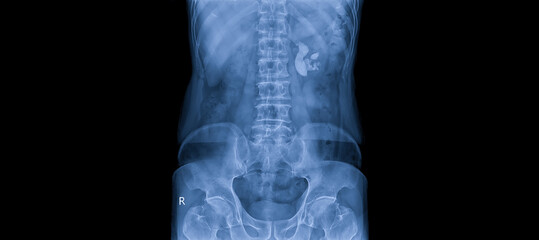 Photo of plain radiograph on dark background in hospital. The film use for diagnosis the illness of patient.Medical concept.Film shown stag horns stone or renal calculi in right kidney.