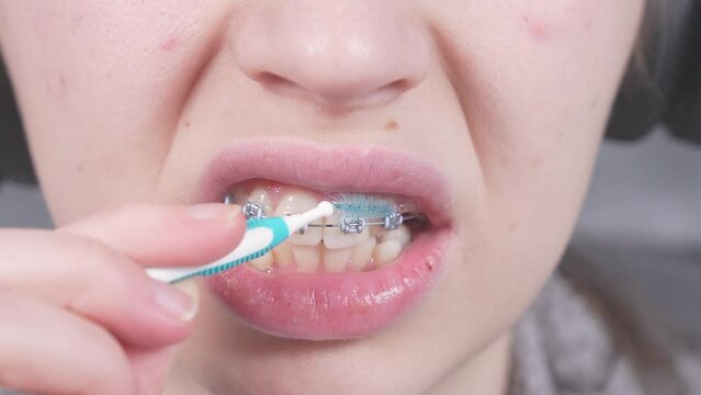 Teenager brushing metal brackets by orthodontic toothbrushes, dental floss. Dental care hygiene concept with braces. Cleaning braces teeth system, close-up. Oral care concept with braces.