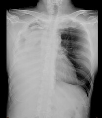 Chest x-ray image showing right pleural effusion.