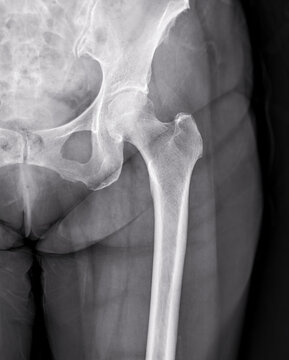 X-ray  of Left hip  joint front view.