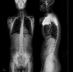 X-ray image of Whole  Spine  for diagnosis scoliosis of spine.