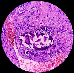 Oral submucous fibrosis (OSF), abnormal collagen deposition. precancerous disorder and transforms. Photomicrograph,