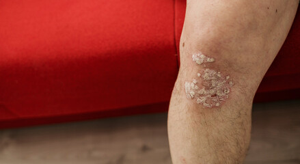 psoriasis on a man's leg